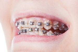 Braces need care to keep from being damaged