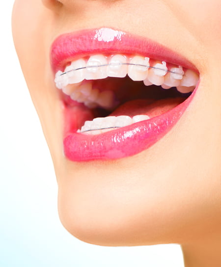 braces Invisalign dentist in Airdrie