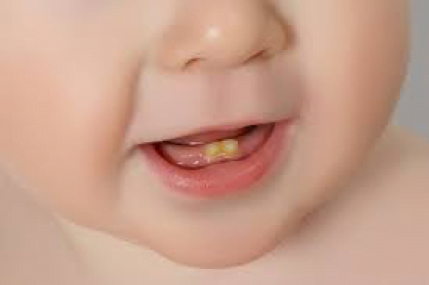 Avoid Baby Bottle Tooth Decay