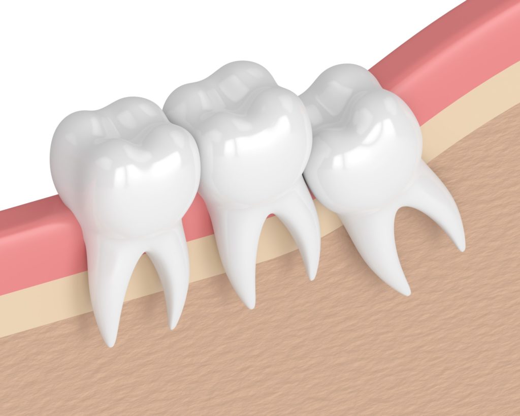 Impacted wisdom tooth