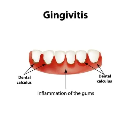 Gingivitis-Gum-Disease-or-Periodontal-Disease-Signs-Symptoms-Cause-and-Cure