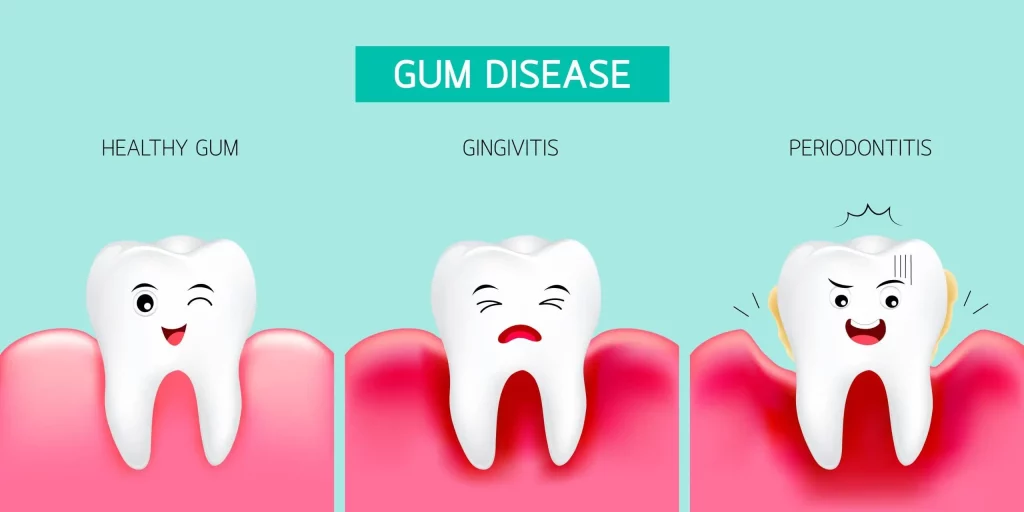 clipart stages of gum disease
