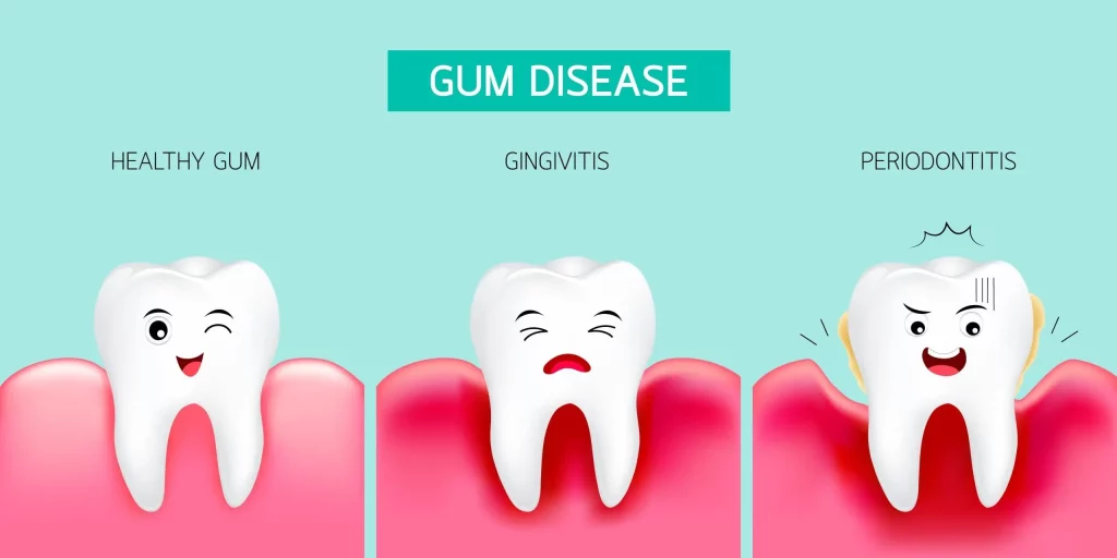 Gingivitis Signs, Symptoms, Cause and Cure - Gum Disease