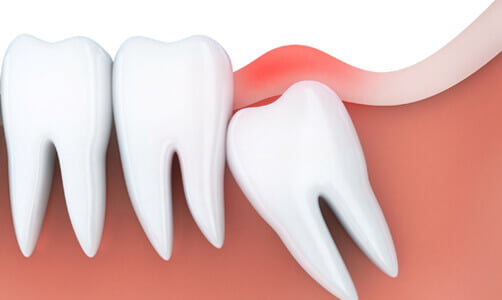 Wisdom Teeth Removal - Airdrie Springs Dental