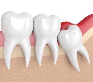 Wisdom Teeth Removal Airdrie