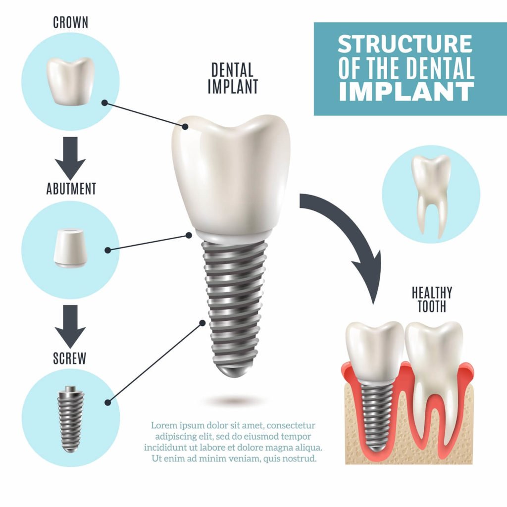 dental implants airdrie dentist