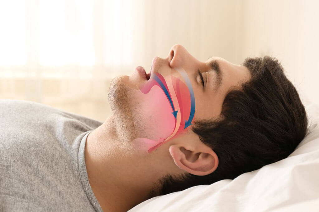 sleep apnea airdrie dentist