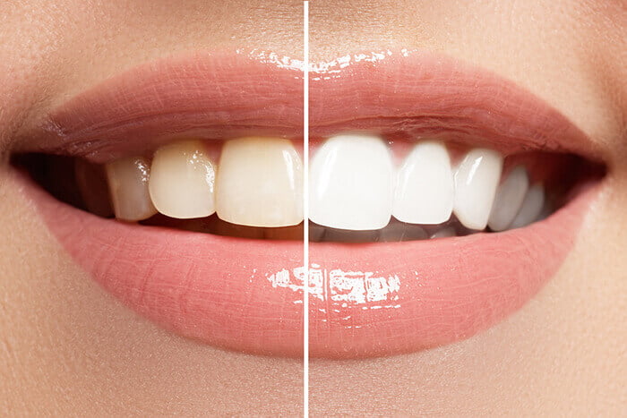 teeth-whitening_one