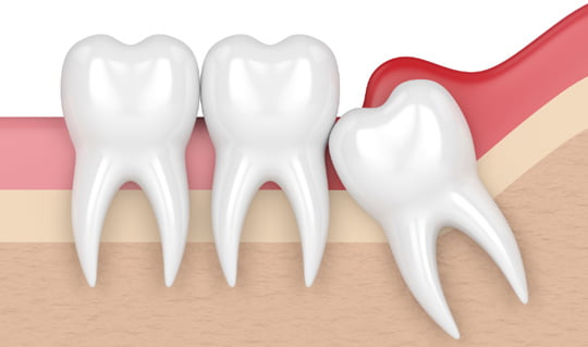 wisdom teeth- Airdrie Springs Dental