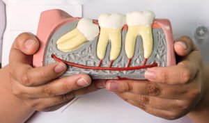 wisdom teeth removal Airdrie springs dental