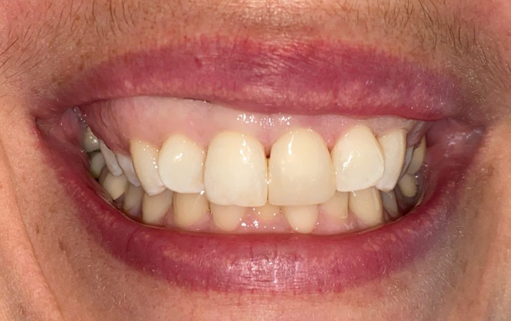 filling-scaled treatment by airdrie dentist