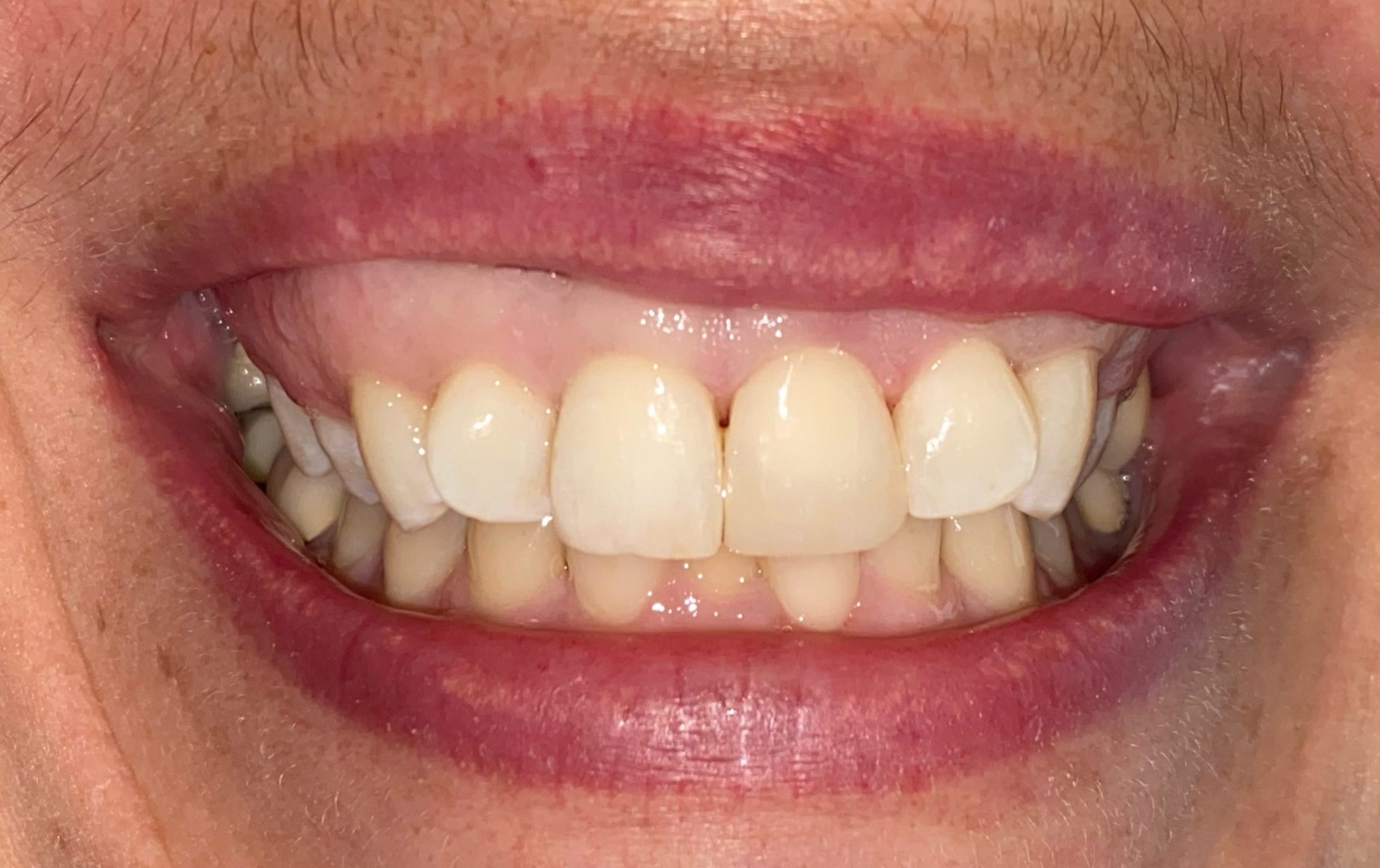 Dental Fillings Smile Reveal Airdrie Springs Dental