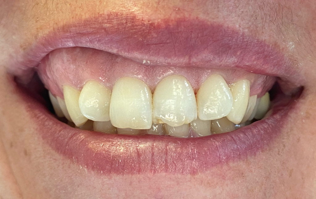 filling-scaled treatment by airdrie dentist