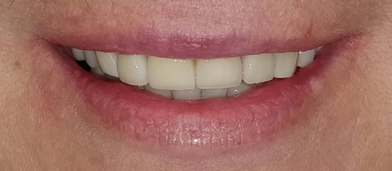Smile Reveal #4 - Airdrie Springs Dental