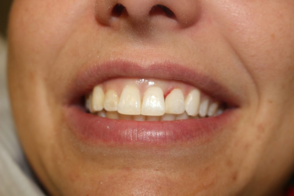 image after dental filling treatment