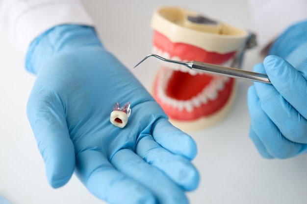 root canal treatment and procedure in Airdrie
