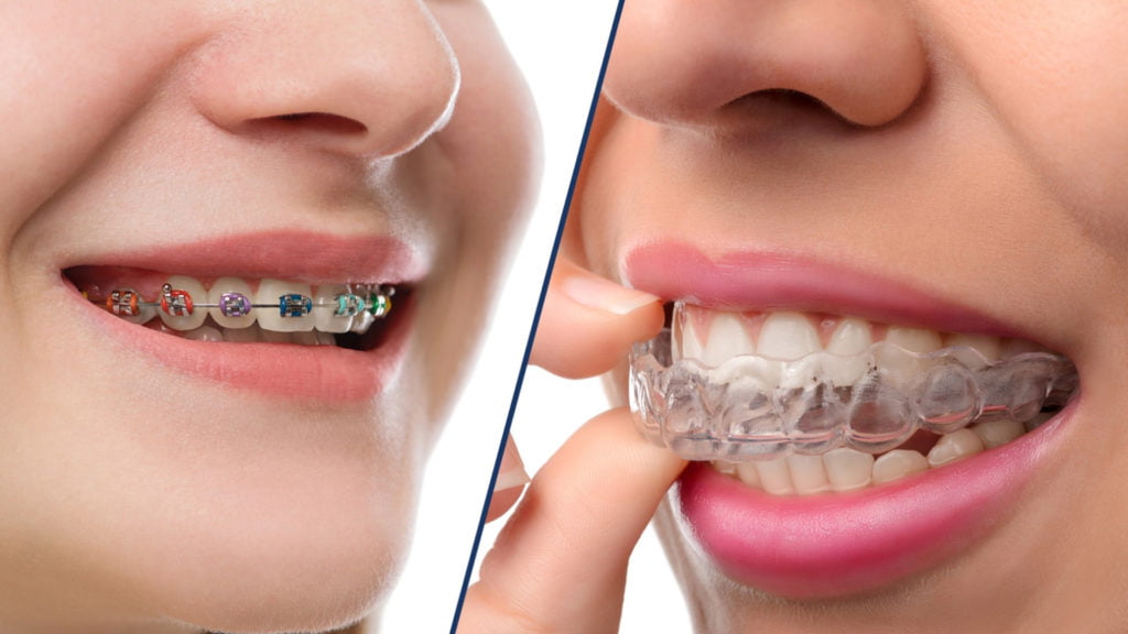 Invisalign vs. Braces tips for caring for your dental braces