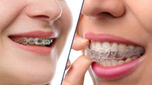 Invisalign vs. Braces