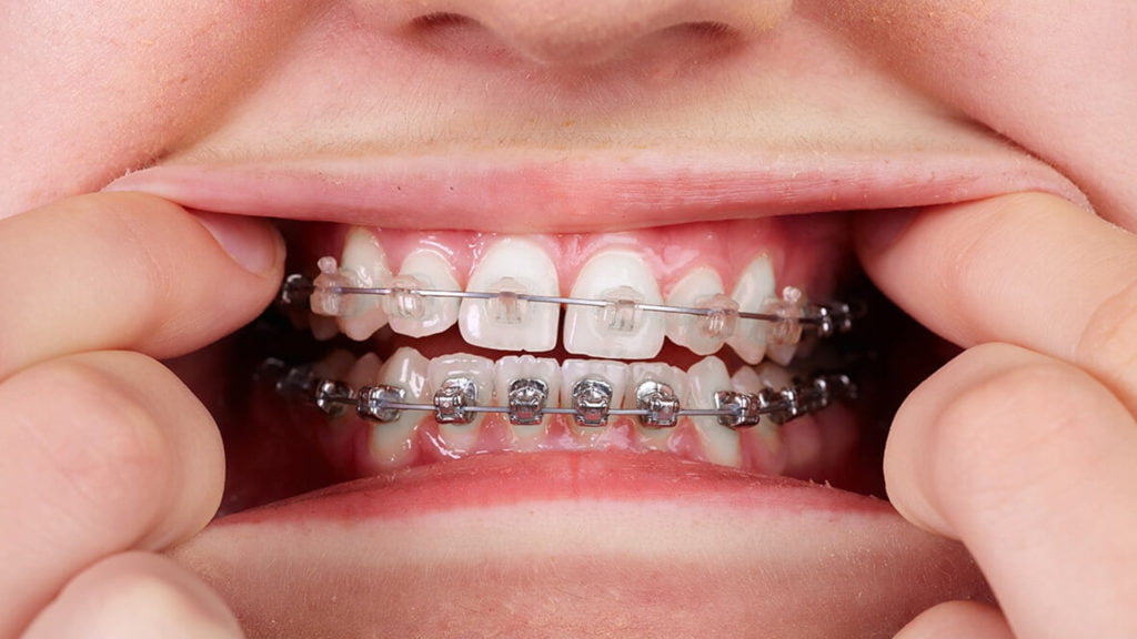 Metal Braces or Ceramic Braces dentist Airdrie Alberta