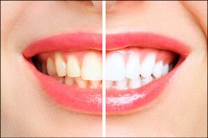 Discolored Teeth Airdrie Alberta