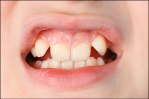 Misaligned Teeth Airdrie Alberta