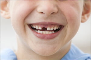 Missing Teeth Airdrie Alberta