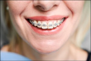 Teeth Braces And Crowns Airdrie Alberta
