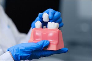 Teeth Implants Airdrie Alberta