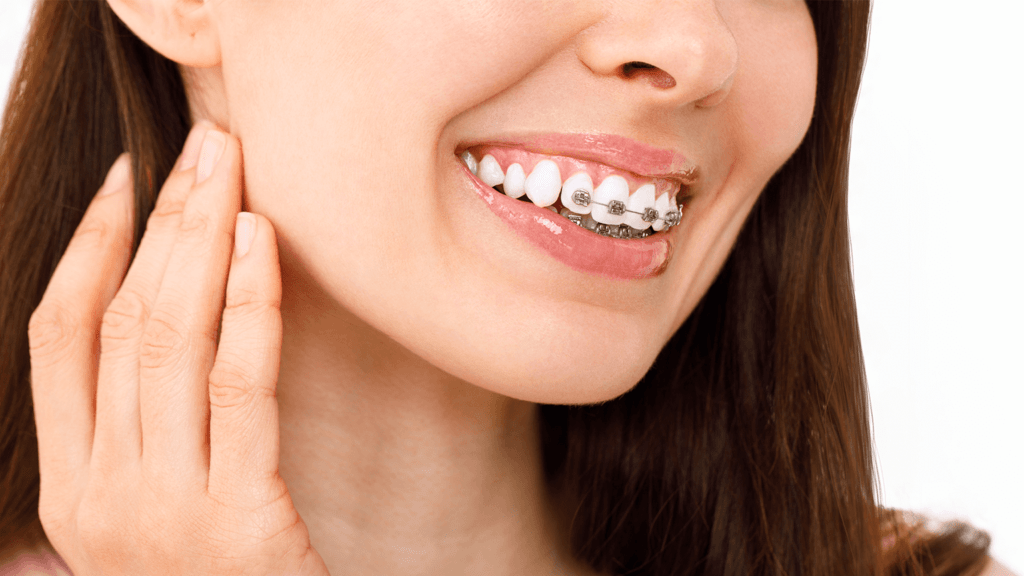 Dental Braces Straightening Your Teeth - Aridrie Springs Dental