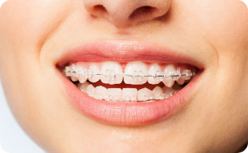 Ceramic Braces - orthodontics