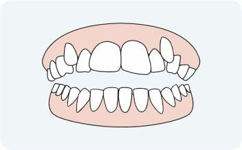 Crooked teeth - orthodontics