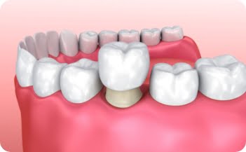 dental Crowns