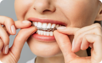 Invisalign Braces