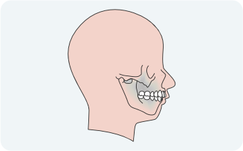 Jaw Problem