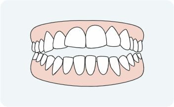 Open bite - orthodontics