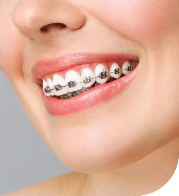 Orthodontic braces