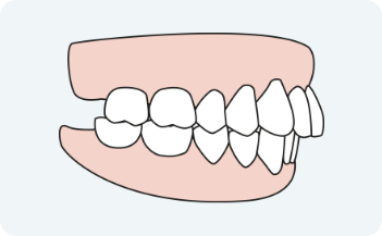 Overbite - orthodontics