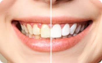 Tooth Whitening