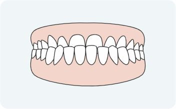 Underbite