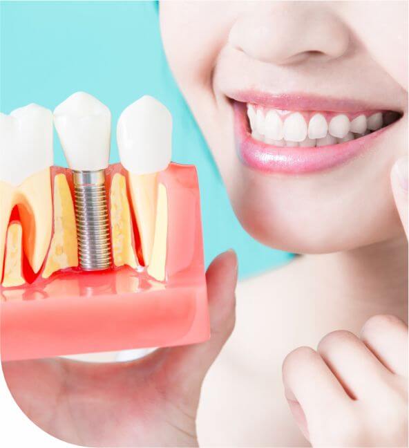 Are You a Good Candidate for Dental Implants?