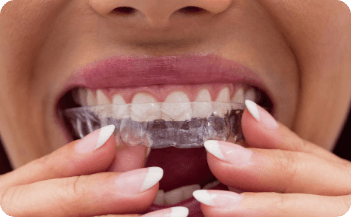 Invisalign