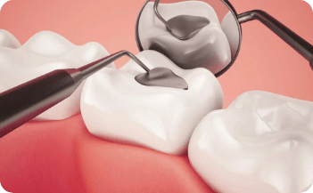 Dental Fillings