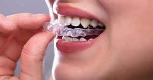 Orthodontic Treatment