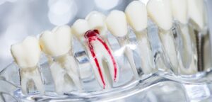 10 common signs you need a root canal