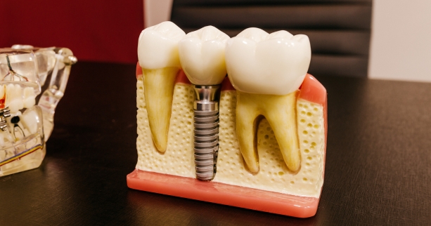 why you should choose dental implants to replace teeth