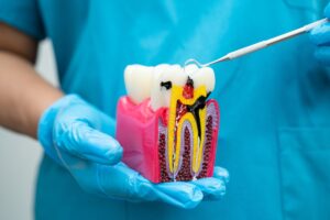 root-canal-therapy-in-Airdrie